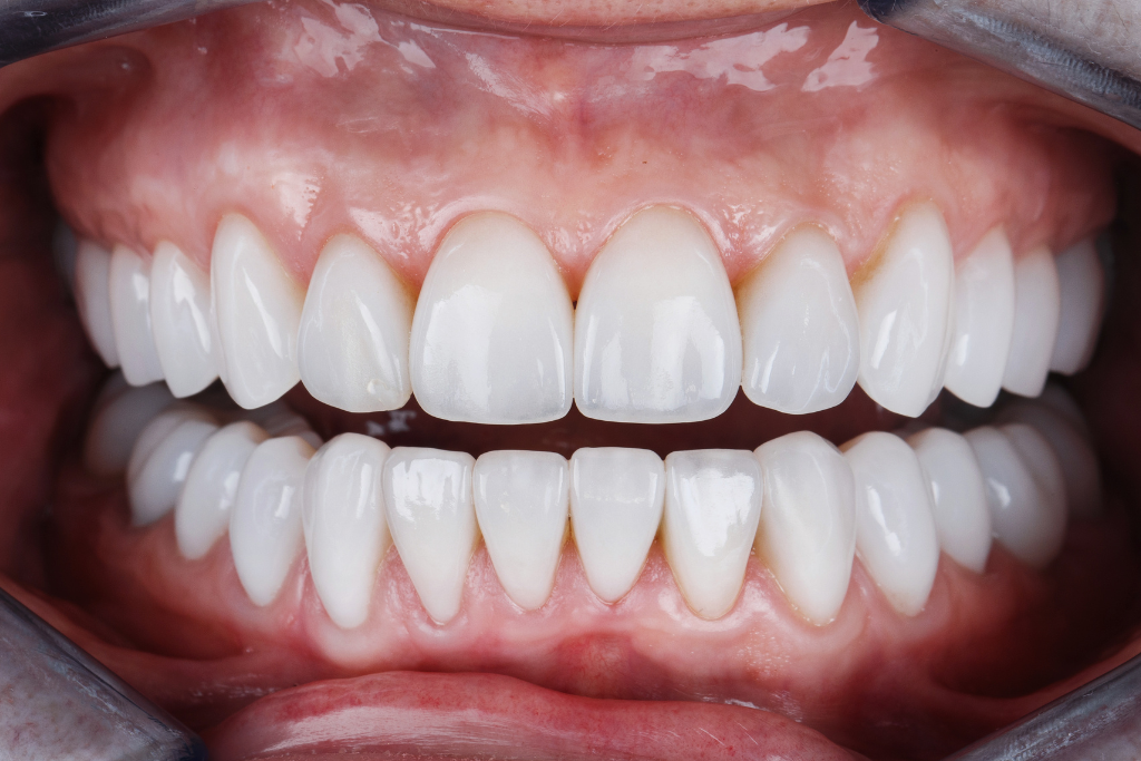 Veneers Treatment  - Medicred